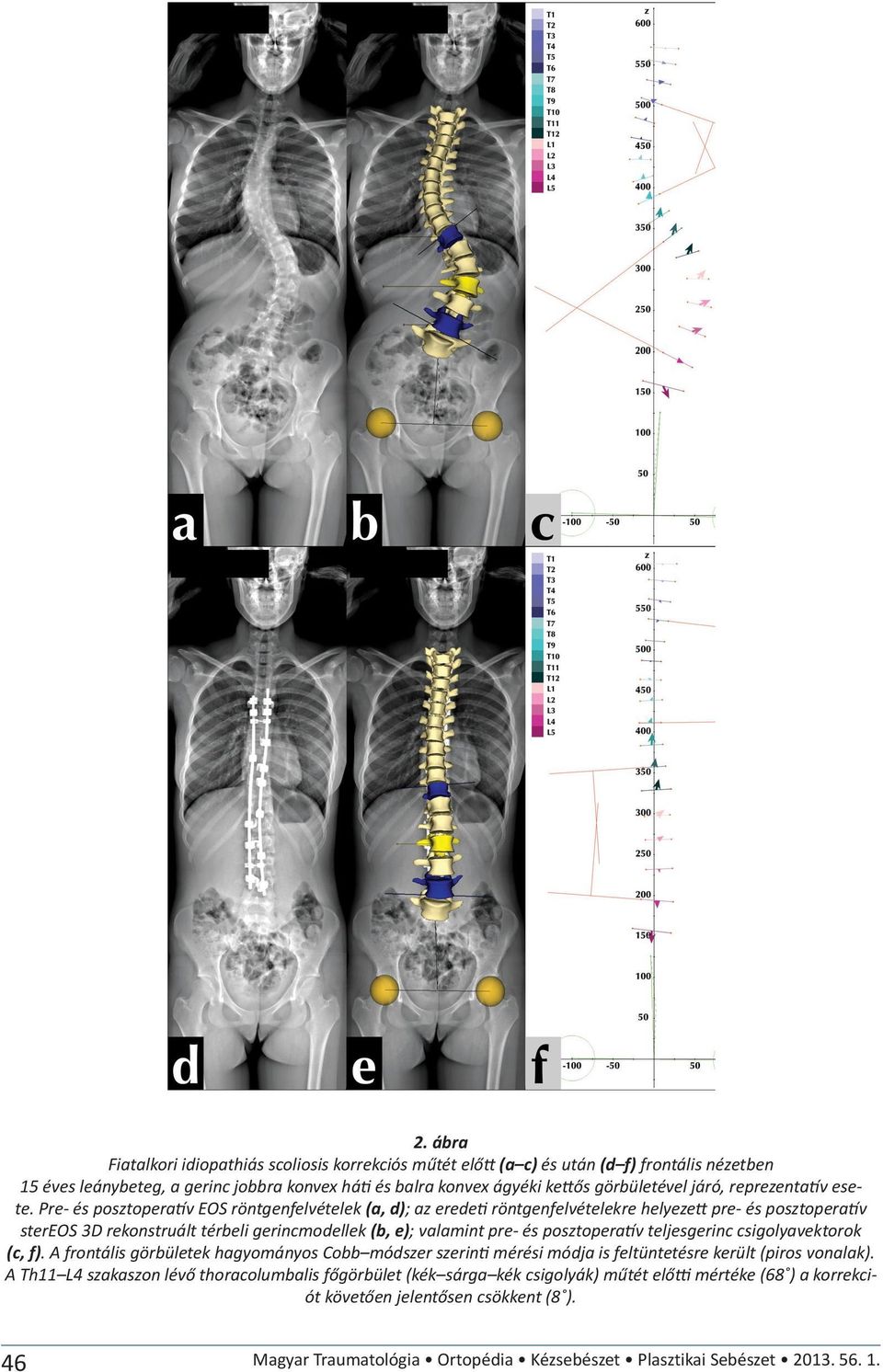 Pre- és posztopera v EOS röntgenfelvételek (a, d); az erede röntgenfelvételekre helyeze pre- és posztopera v stereos 3D rekonstruált térbeli gerincmodellek (b, e); valamint pre- és posztopera v