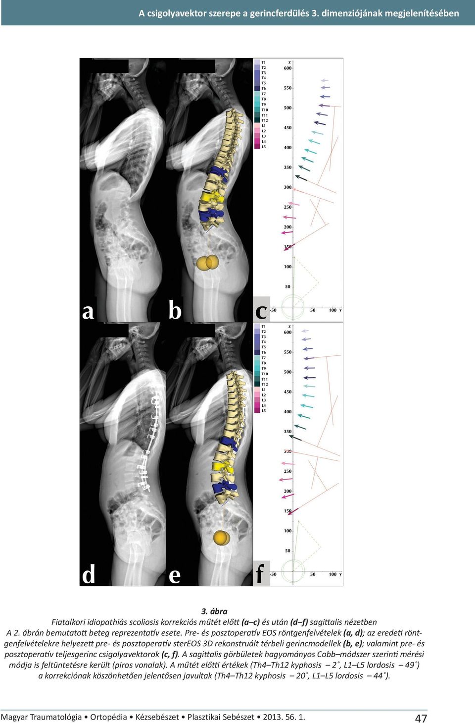 Pre- és posztopera v EOS röntgenfelvételek (a, d); az erede röntgenfelvételekre helyeze pre- és posztopera v stereos 3D rekonstruált térbeli gerincmodellek (b, e); valamint pre- és posztopera v