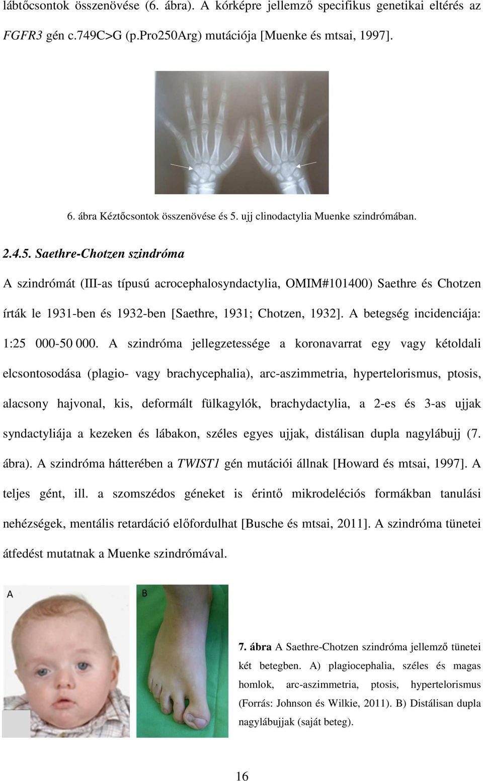 Saethre-Chotzen szindróma A szindrómát (III-as típusú acrocephalosyndactylia, OMIM#101400) Saethre és Chotzen írták le 1931-ben és 1932-ben [Saethre, 1931; Chotzen, 1932].