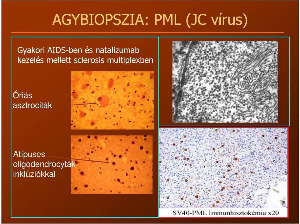 mellett sclerosis multiplexben Óriás