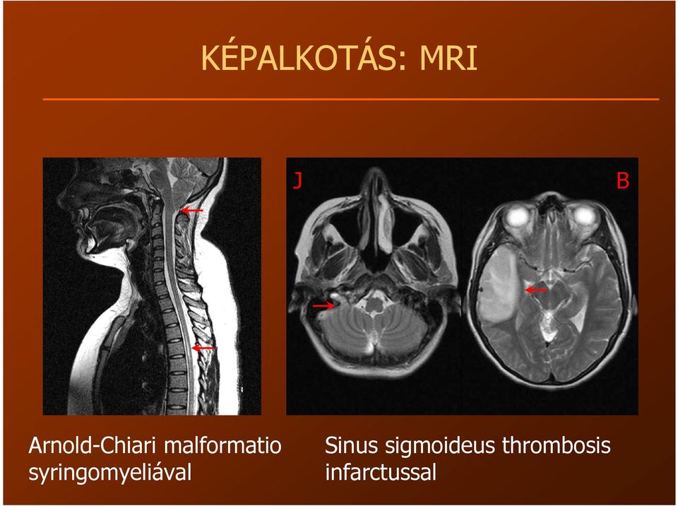 syringomyeliával Sinus