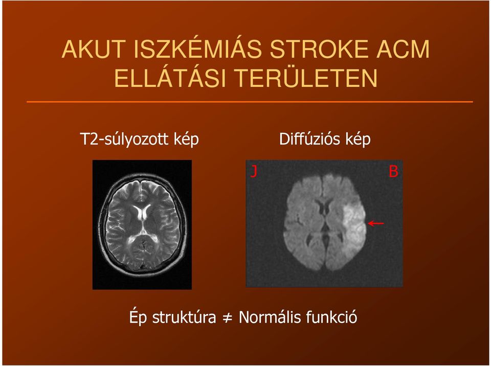 T2-súlyozott kép Diffúziós