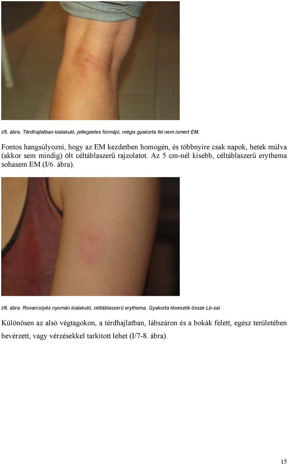 Az 5 cm-nél kisebb, céltáblaszerű erythema sohasem EM (I/6. ábra). I/6. ábra. Rovarcsípés nyomán kialakuló, céltáblaszerű erythema.