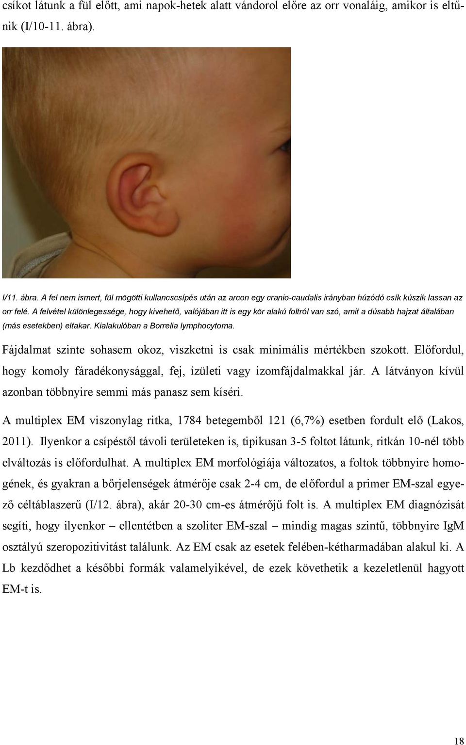 A felvétel különlegessége, hogy kivehető, valójában itt is egy kör alakú foltról van szó, amit a dúsabb hajzat általában (más esetekben) eltakar. Kialakulóban a Borrelia lymphocytoma.