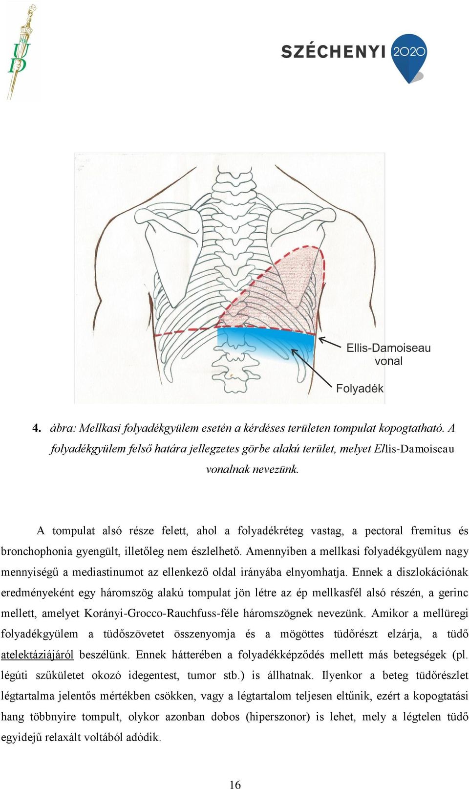 Amennyiben a mellkasi folyadékgyülem nagy mennyiségű a mediastinumot az ellenkező oldal irányába elnyomhatja.