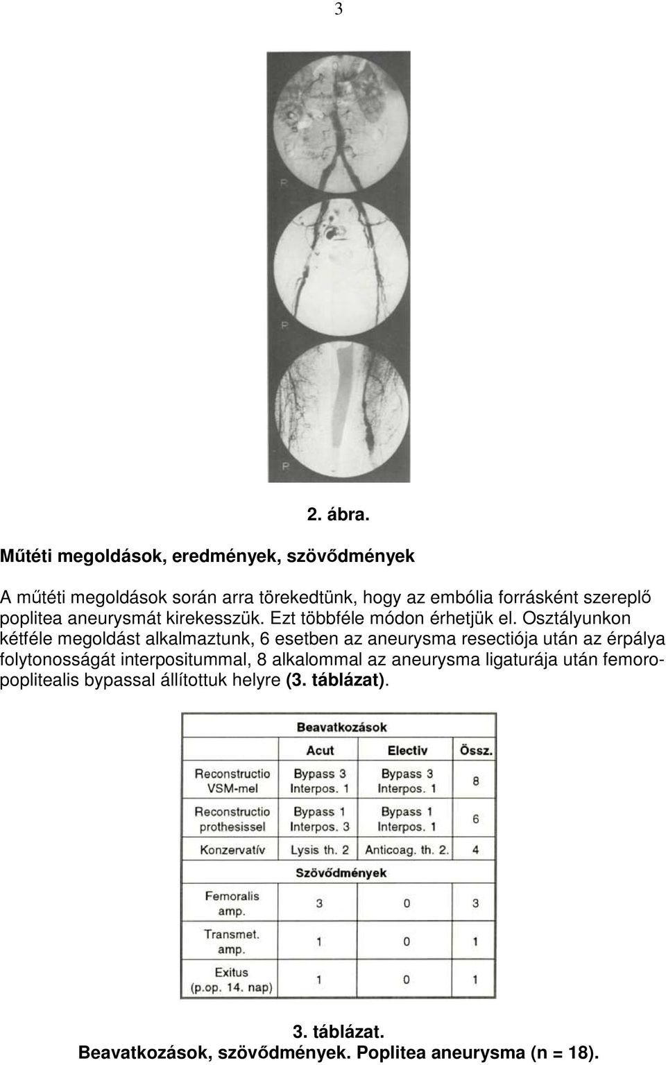 poplitea aneurysmát kirekesszük. Ezt többféle módon érhetjük el.