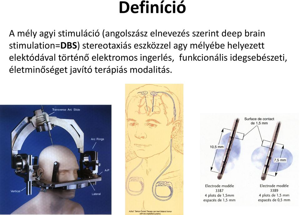 agy mélyébe helyezett elektódával történő elektromos