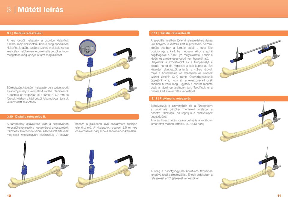 A proximalis célzókar finom mozgatása megkönnyíti a furat megtalálását. A speciális furatban történő reteszeléshez vissza kell helyezni a distalis kart a proximalis célzóra.