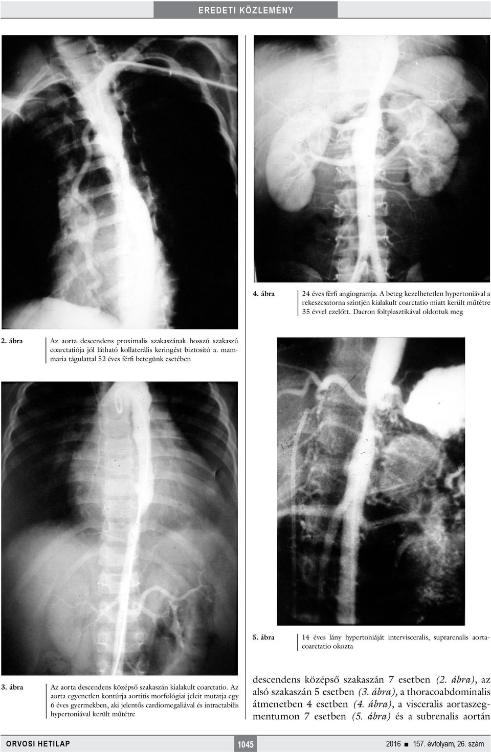 ábra 4 éves lány hypertoniáját intervisceralis, suprarenalis aortacoarctatio okozta 3. ábra Az aorta descendens középső szakaszán kialakult coarctatio.