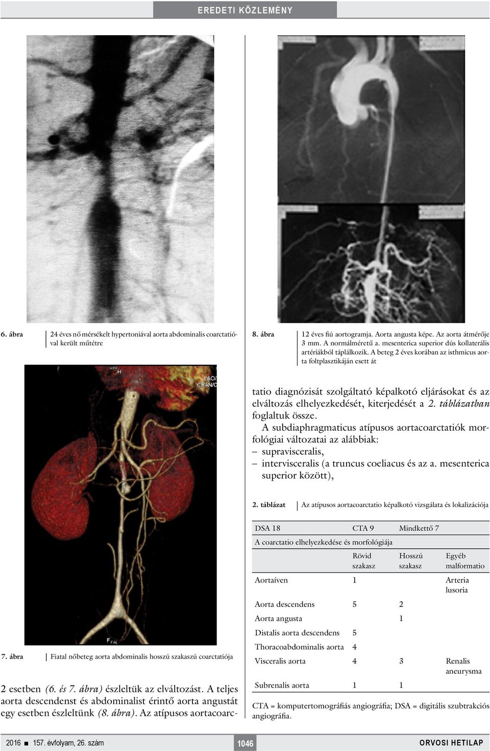 A teljes aorta descendenst és abdominalist érintő aorta angustát egy esetben észleltünk (8. ábra).