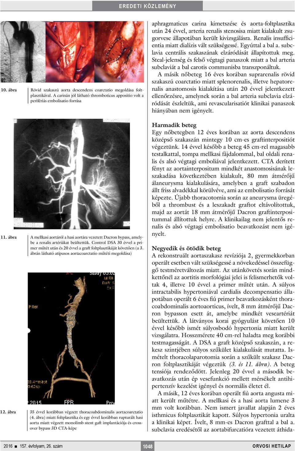 ábrán látható atípusos aortacoarctatio műtéti megoldása) 2. ábra 35 évvel korábban végzett thoracoabdominalis aortacoarctatio (4.