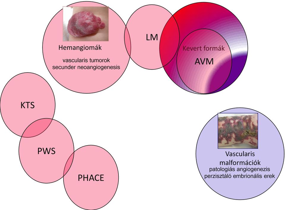 PWS PHACE Vascularis malformációk