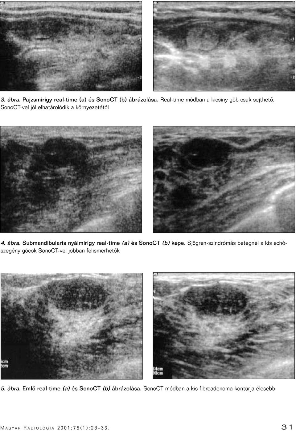 Submandibularis nyálmirigy real-time (a) és SonoCT (b) képe.