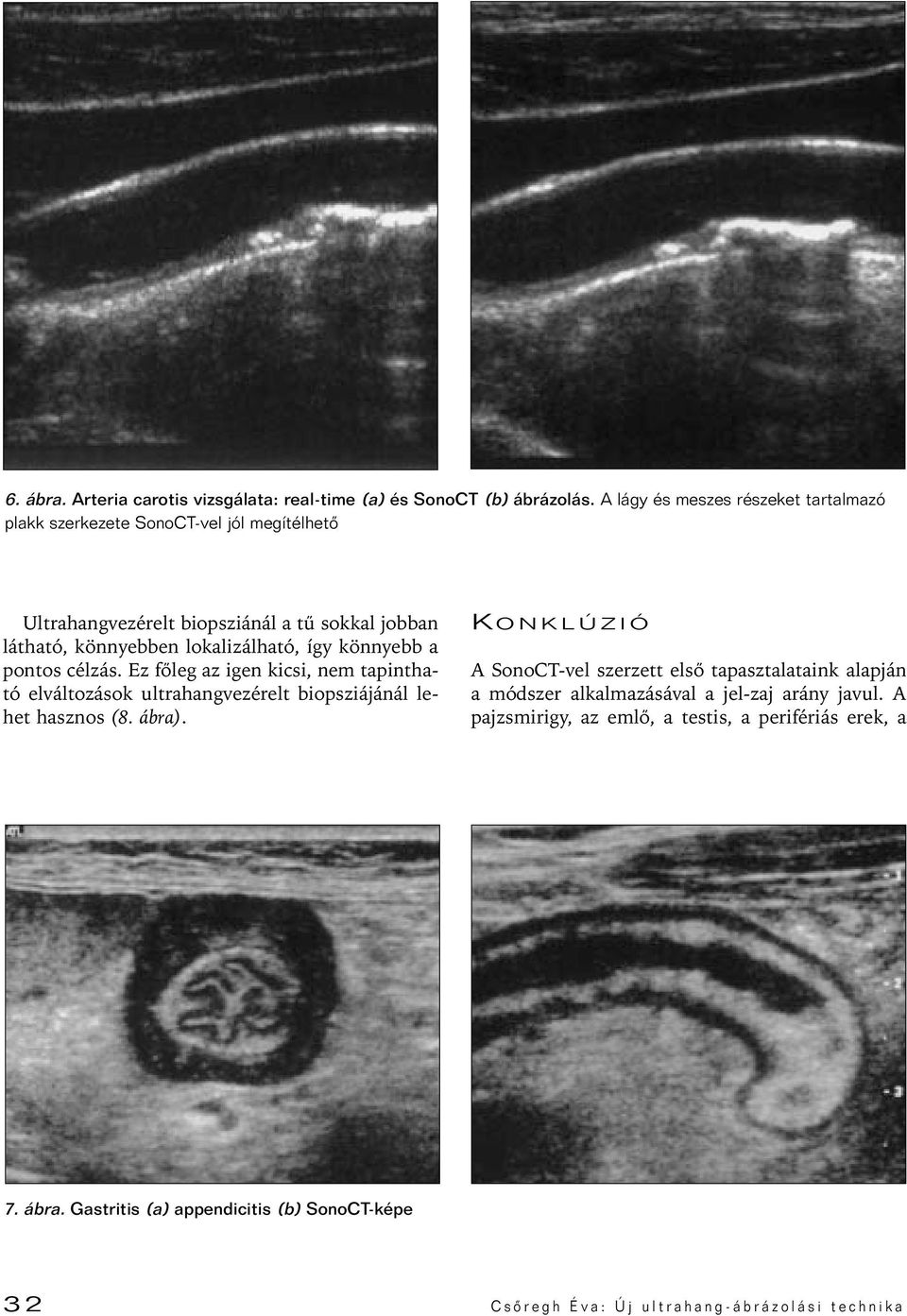 lokalizálható, így könnyebb a pontos célzás. Ez fôleg az igen kicsi, nem tapintható elváltozások ultrahangvezérelt biopsziájánál lehet hasznos (8. ábra).