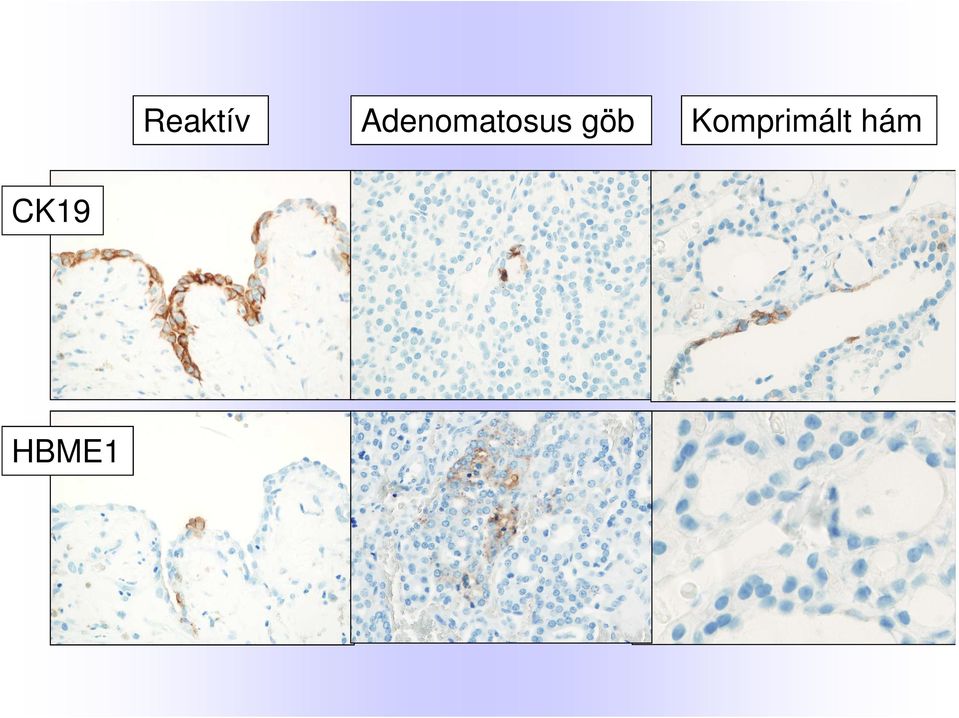 Adenomatosus