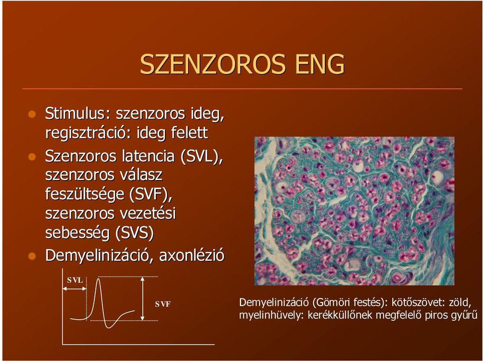 (SVS) Demyelinizáci ció, axonlézi zió SVL SZENZOROS ENG SVF Demyelinizáció