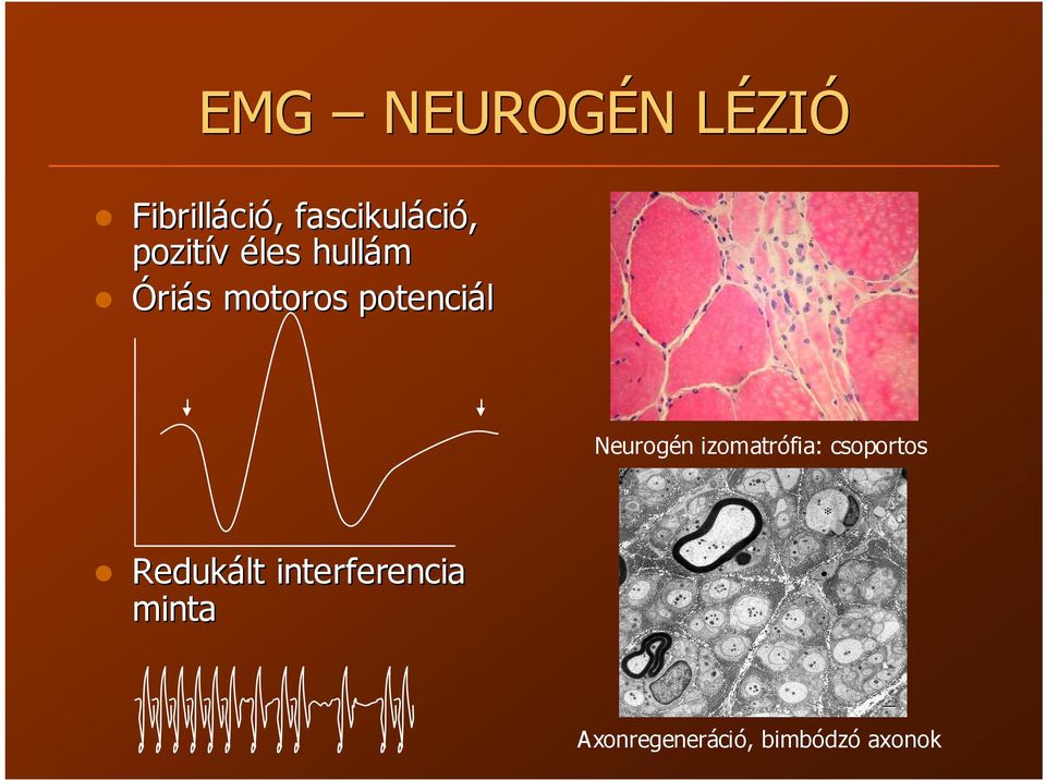 potenciál Neurogén izomatrófia: csoportos Redukált