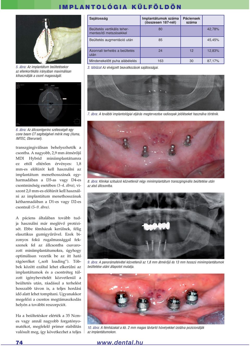 24 12 12,83% Mindenekelôtt puha alábélelés 163 30 87,17% 7. ábra: A további implantológiai eljárás megtervezése radioopak jelöléseket használva történik. 6.
