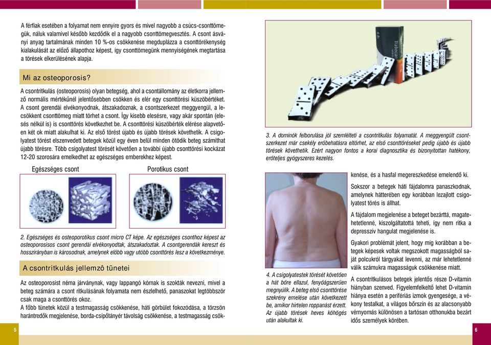 alapja. Mi az osteoporosis? A csontritkulás (osteoporosis) olyan betegség, ahol a csontállomány az életkorra jellemzô normális mértékûnél jelentôsebben csökken és elér egy csonttörési küszöbértéket.