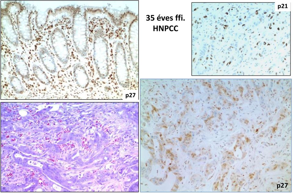 HNPCC p21