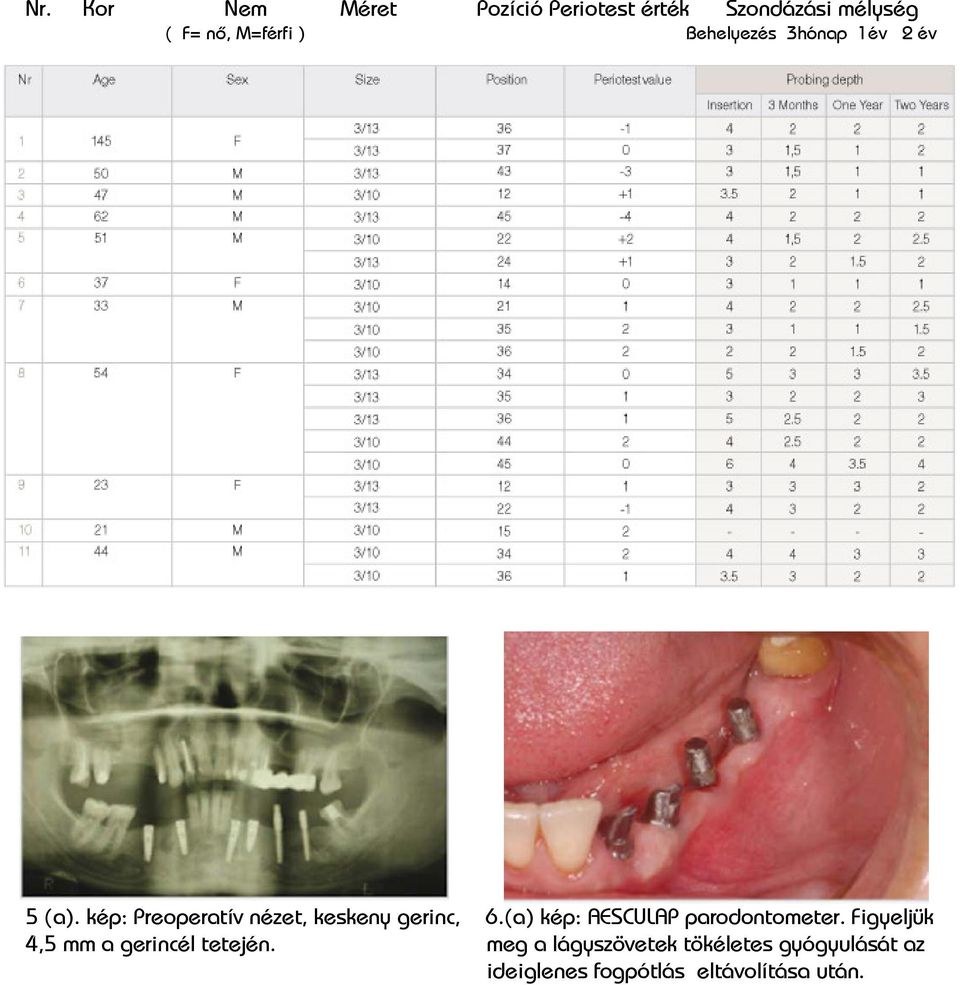 (a) kép: AESCULAP parodontometer. Figyeljük 4,5 mm a gerincél tetején.