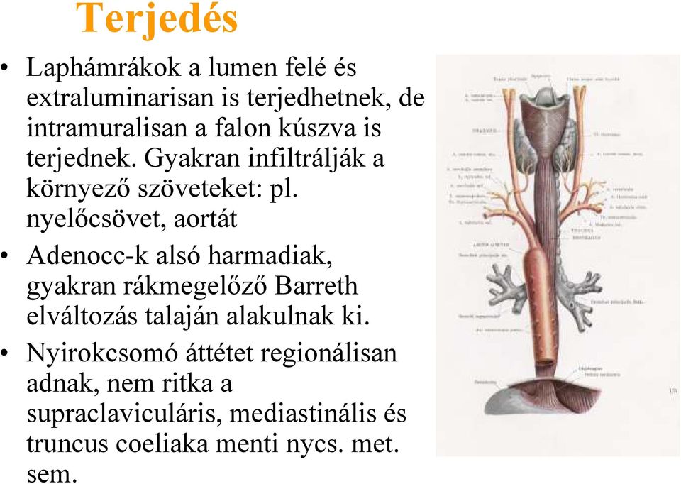 nyelőcsövet, aortát Adenocc-k alsó harmadiak, gyakran rákmegelőző Barreth elváltozás talaján