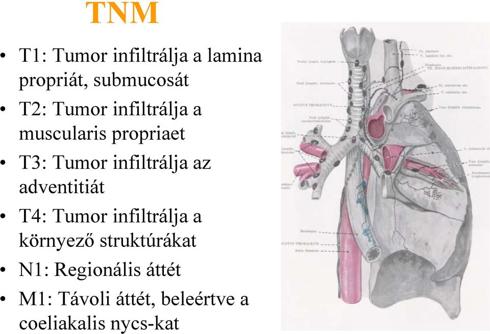 az adventitiát T4: Tumor infiltrálja a környező struktúrákat