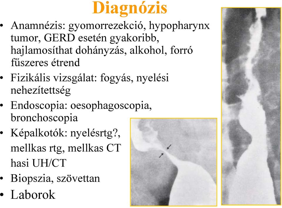 fogyás, nyelési nehezítettség Endoscopia: oesophagoscopia, bronchoscopia