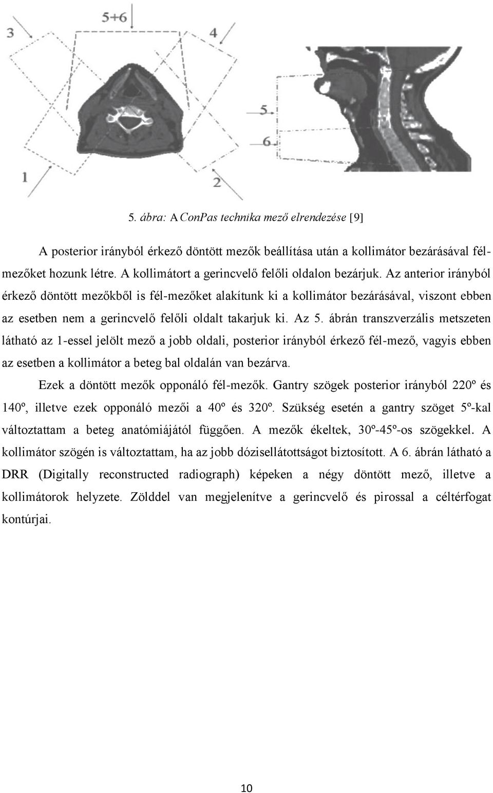 Az anterior irányból érkező döntött mezőkből is fél-mezőket alakítunk ki a kollimátor bezárásával, viszont ebben az esetben nem a gerincvelő felőli oldalt takarjuk ki. Az 5.
