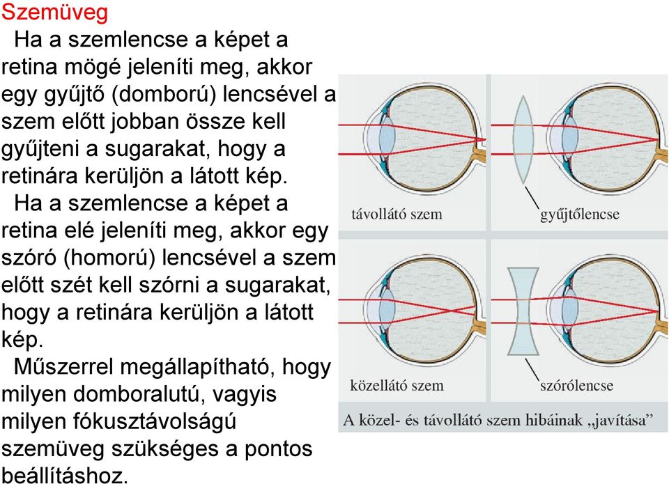 Ha a szemlencse a képet a retina elé jeleníti meg, akkor egy szóró (homorú) lencsével a szem előtt szét kell szórni a