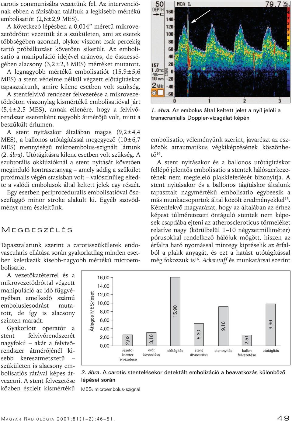 Az embolisatio a manipuláció idejével arányos, de összességében alacsony (3,2±2,3 MES) mértéket mutatott.