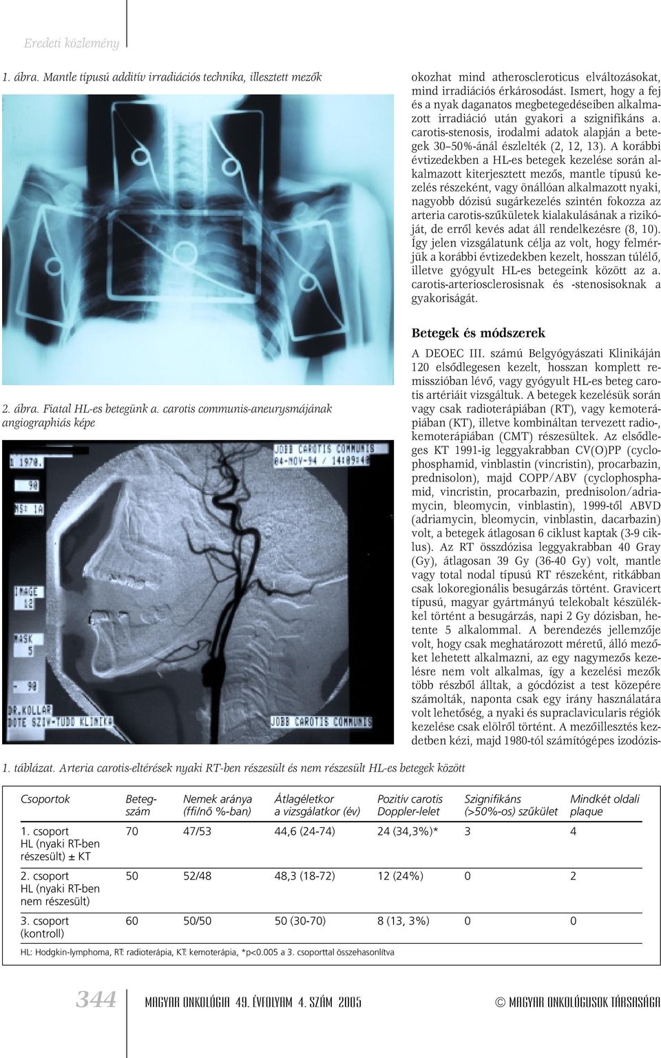 Ismert, hogy a fej és a nyak daganatos megbetegedéseiben alkalmazott irradiáció után gyakori a szignifikáns a. carotis-stenosis, irodalmi adatok alapján a betegek 30 50%-ánál észlelték (2, 12, 13).