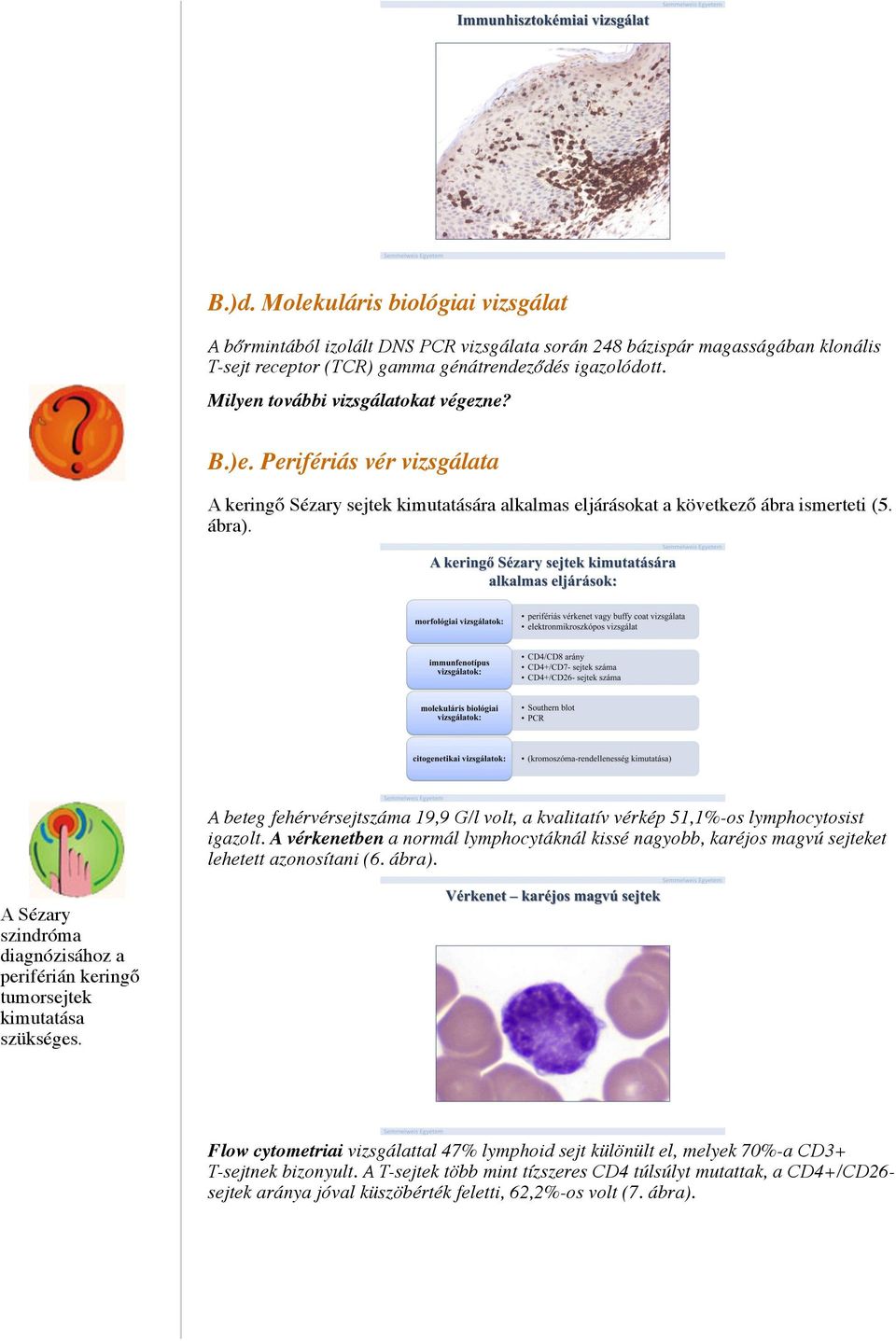 A beteg fehérvérsejtszáma 19,9 G/l volt, a kvalitatív vérkép 51,1%-os lymphocytosist igazolt. A vérkenetben a normál lymphocytáknál kissé nagyobb, karéjos magvú sejteket lehetett azonosítani (6.