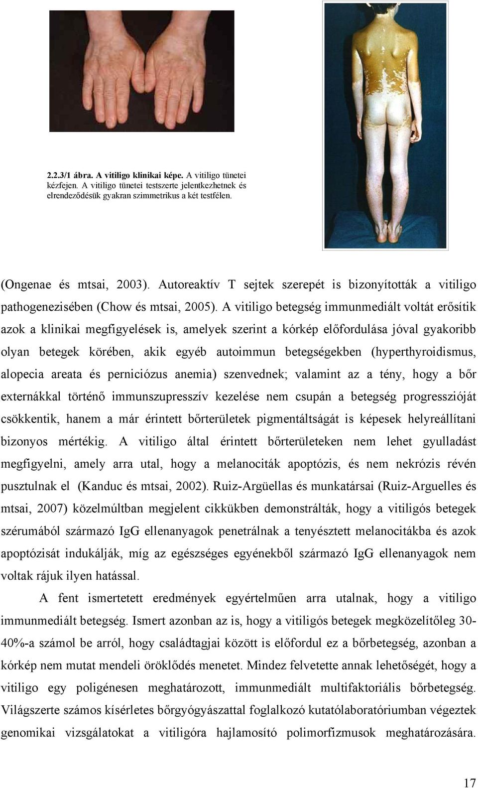 A vitiligo betegség immunmediált voltát erősítik azok a klinikai megfigyelések is, amelyek szerint a kórkép előfordulása jóval gyakoribb olyan betegek körében, akik egyéb autoimmun betegségekben