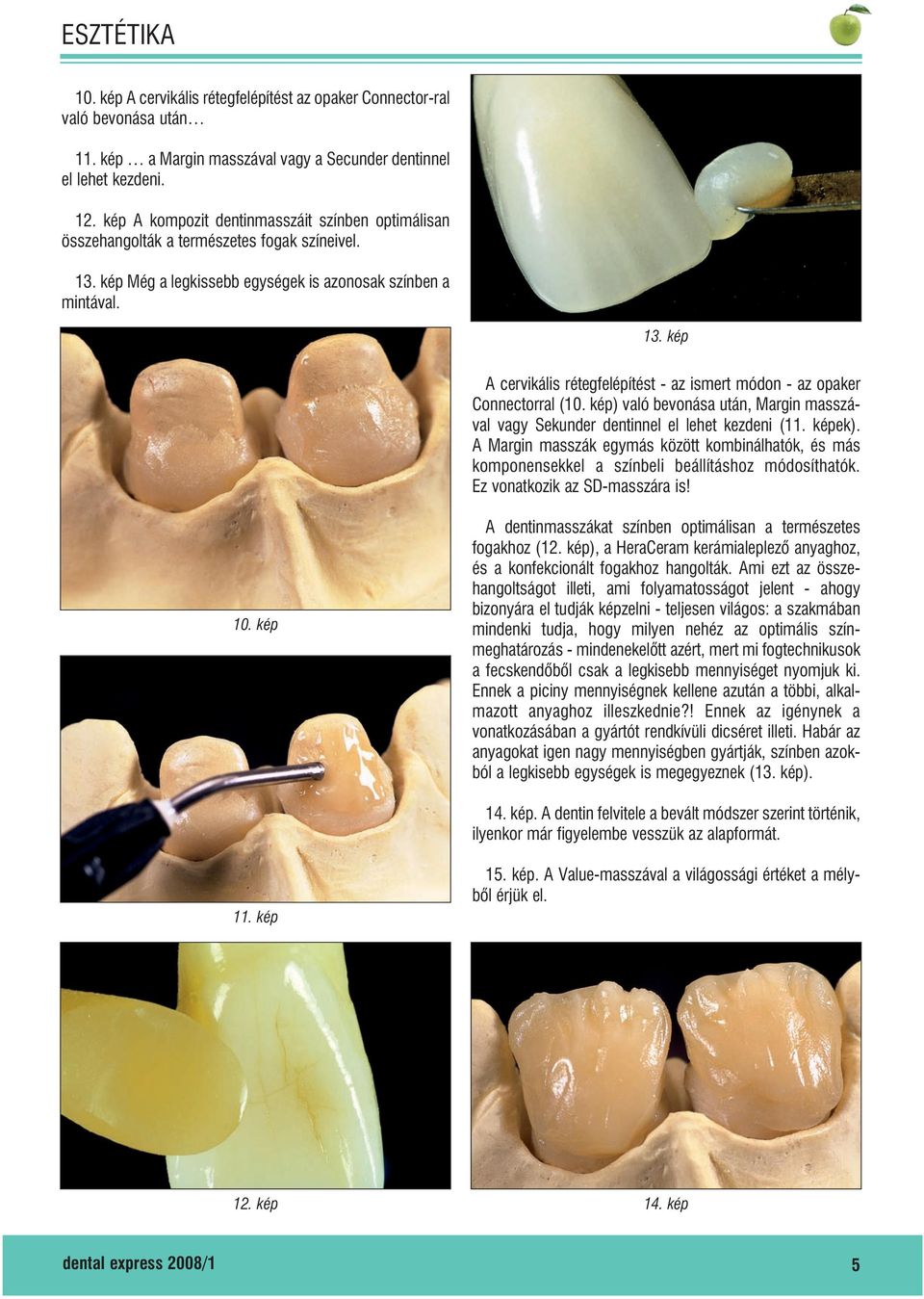 kép) való bevonása után, Margin masszával vagy Sekunder dentinnel el lehet kezdeni (11. képek).