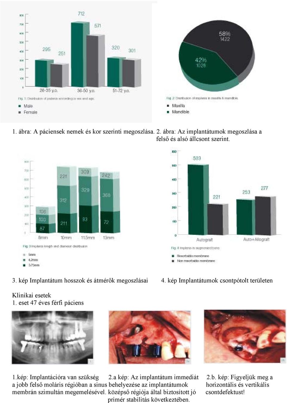 kép: Implantációra van szükség 2.a kép: Az implantátum immediát 2.b.