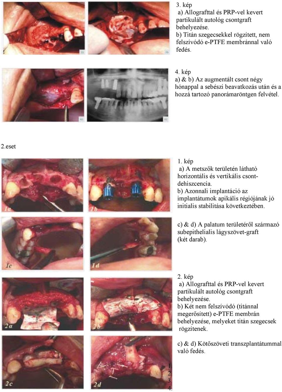 kép a) A metszők területén látható horizontális és vertikális csontdehiszcencia. b) Azonnali implantáció az implantátumok apikális régiójának jó initialis stabilitása következtében.