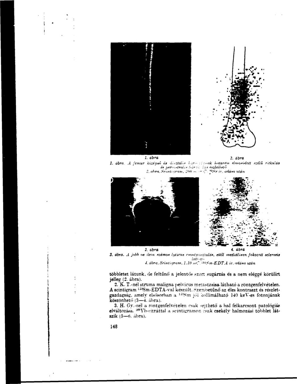 riháin után többletet látunk, de feltűnő a jelentő:* szór:.sugárzás és a nem eléggé körülírt jelleg (2. ábra). 2. K. T.-nél struma maligna pelvicus metastssisa látható a röntgenfelvételen.