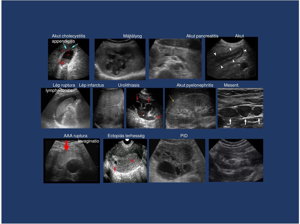 Urolithiasis Akut pyelonephritis Mesent.