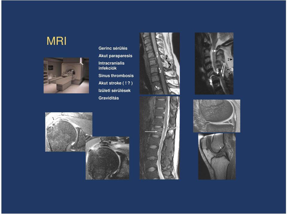 infekciók Sinus thrombosis