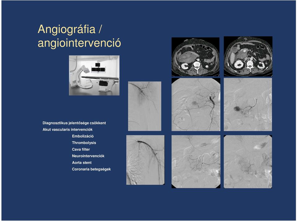 intervenciók Embolizáció Thrombolysis Cava