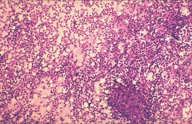 Akut szuppurativ (bacterialis/pyogen) thyreoiditis Prevalencia: igen ritka Veszélyeztettek: idős, leromlott, immunkomprimált betegek Kórokozók: Str. haemol., Str.