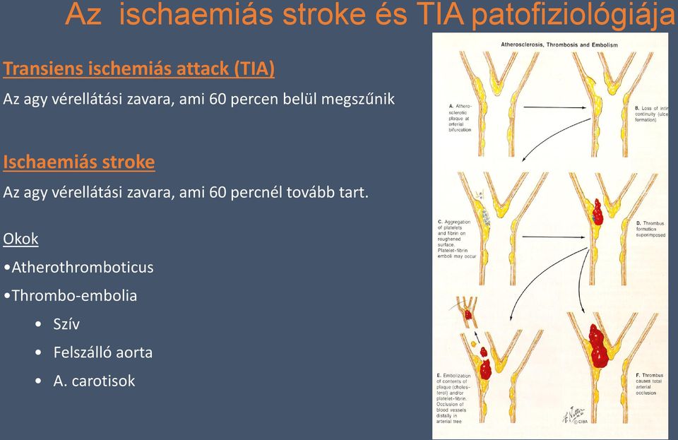 Ischaemiás stroke Az agy vérellátási zavara, ami 60 percnél tovább