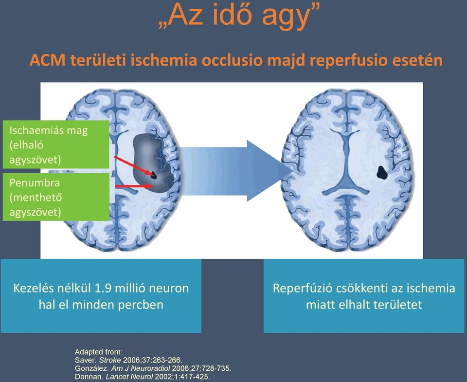 9 millió neuron hal el minden percben Reperfúzió csökkenti az ischemia miatt elhalt