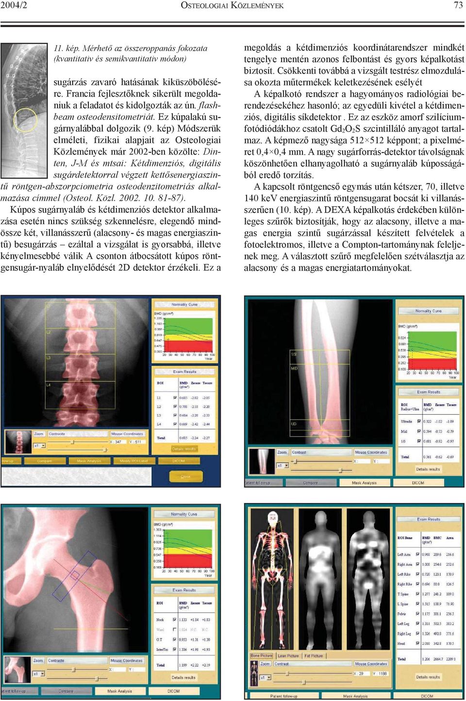 kép) Módszerük elméleti, fizikai alapjait az Osteologiai Közlemények már 2002-ben közölte: Dinten, J-M és mtsai: Kétdimenziós, digitális sugárdetektorral végzett kettõsenergiaszintû