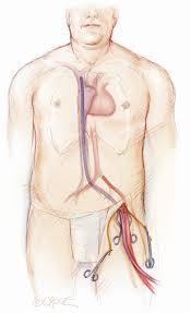 Kanülálás Arterias kanül: Aorta ascendens Arteria anonyma Proximalis ív Arteria axillaris Arteria femoralis A.