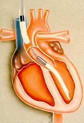 Akut mechanikus keringéstámogatás Hemopump Az aorta ascendensen át a