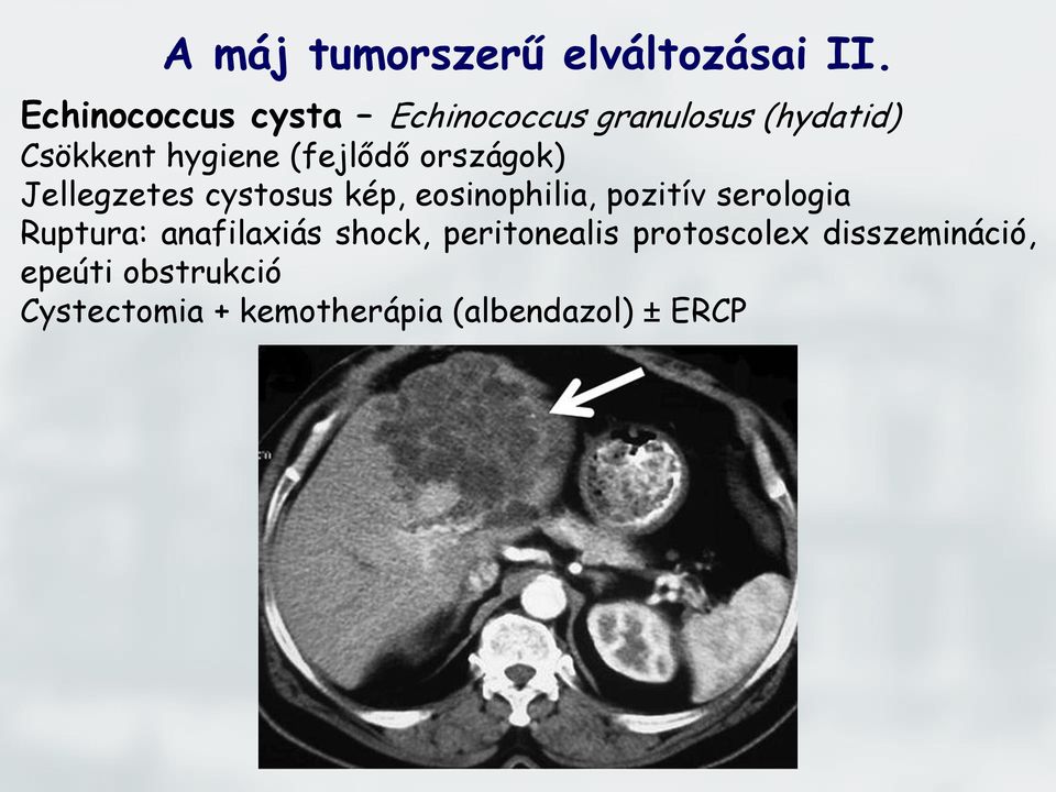 országok) Jellegzetes cystosus kép, eosinophilia, pozitív serologia Ruptura: