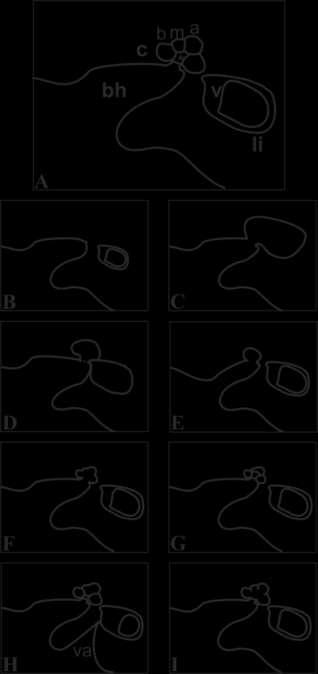 7. Inkomplett partíció III. típus: az interscala septumok jelen vannak, de a modiolus teljesen hiányzik. Normális méretű cochlea (7.I). A csontos csiga fejlődése a 8. gesztációs héten befejeződik.