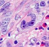 A lymphoid rendszer betegségei Hodgkin lymphoma Sternberg Reed sejt variánsok Klasszikus Hodgkin lymphoma CD 20 + Altípusok: lymphocyta gazdag nodular sclerosis kevert sejtes